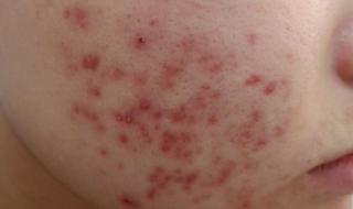 痤疮怎样治 痤疮怎样治