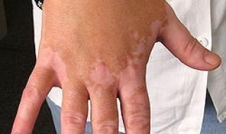 白癜风初期症状图片